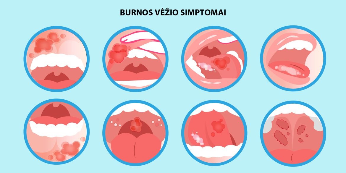 Faktai ir burnos vėžio simptomai