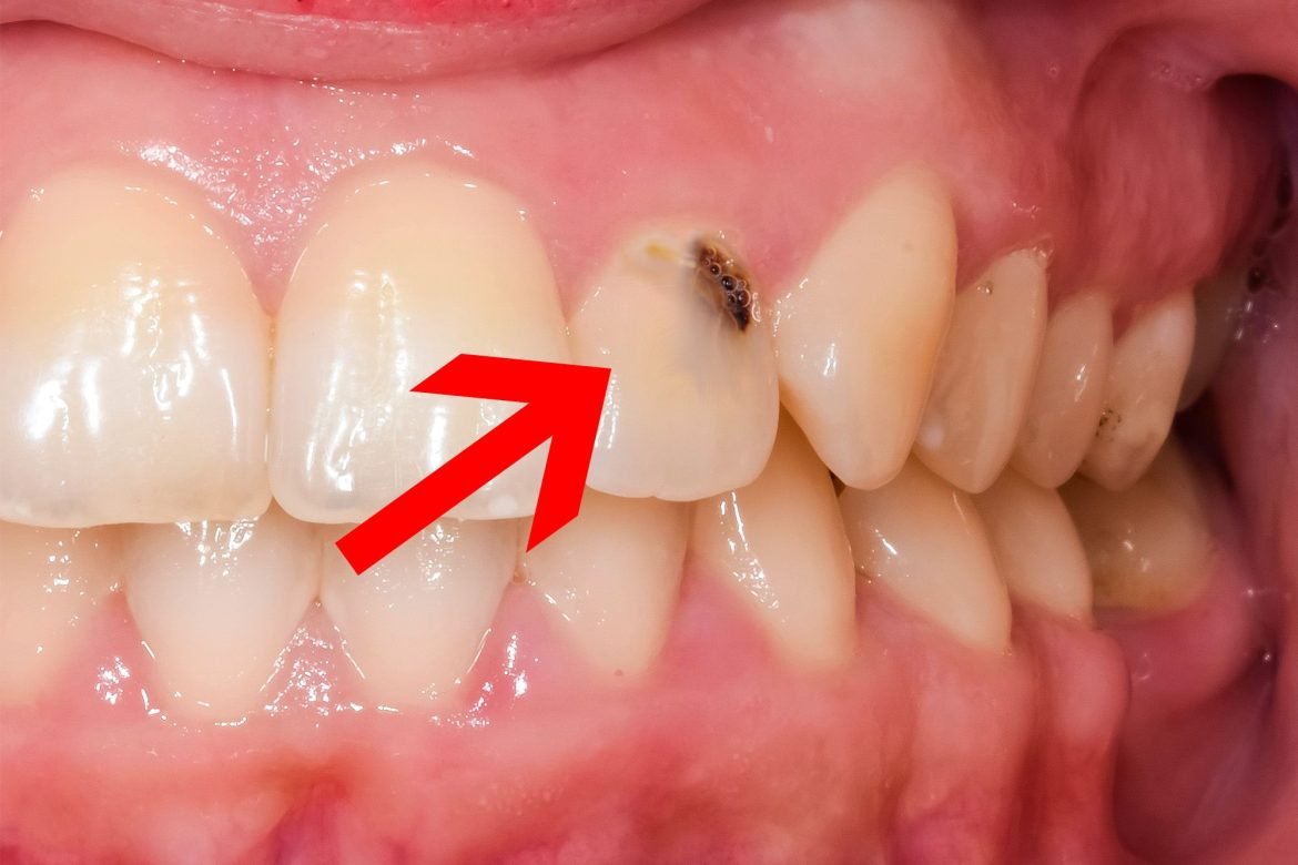 Ar gali atsirasti ertmė ant priekinių dantų?