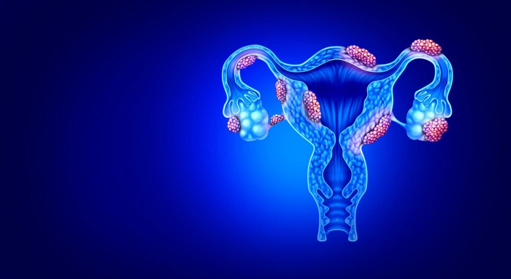 Gilios endometriozės