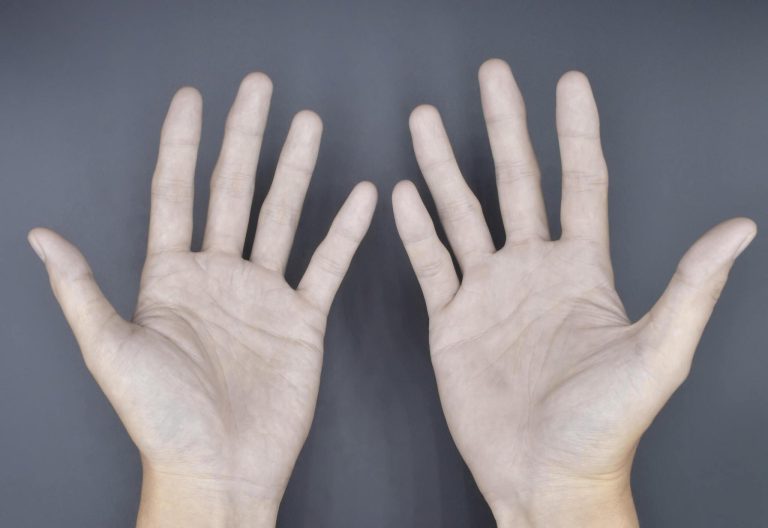 Raynaud sindromas