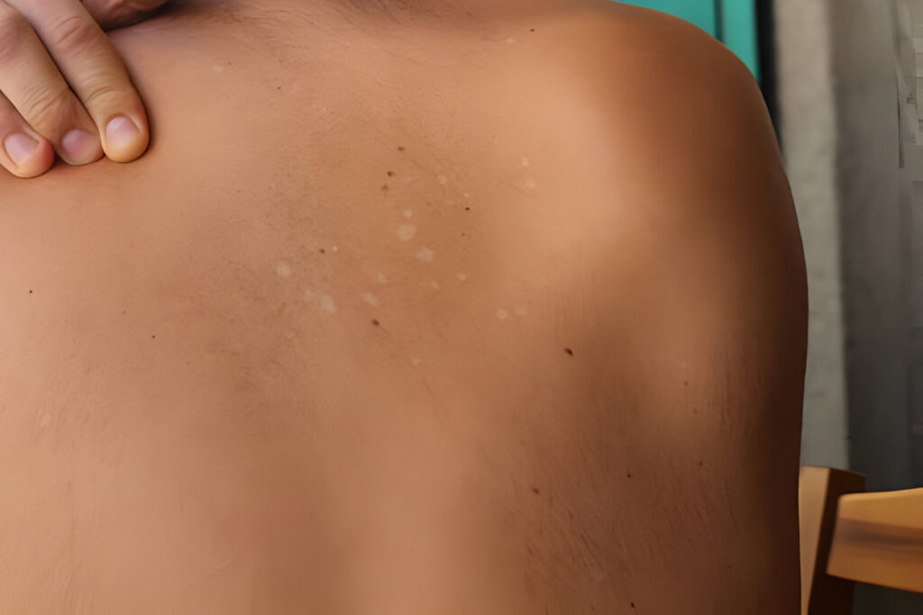 Pityriasis versicolor (kerpės versicolor)