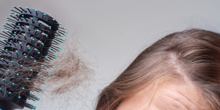 Plaukų slinkimas (alopecija)