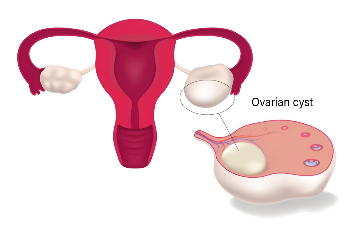 Kiaušidžių cistos iliustracija