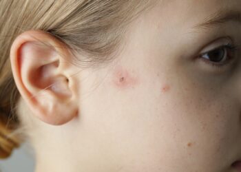 Stafilokokinės infekcijos