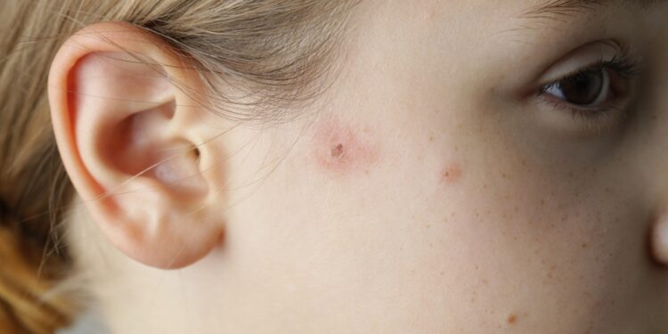 Stafilokokinės infekcijos