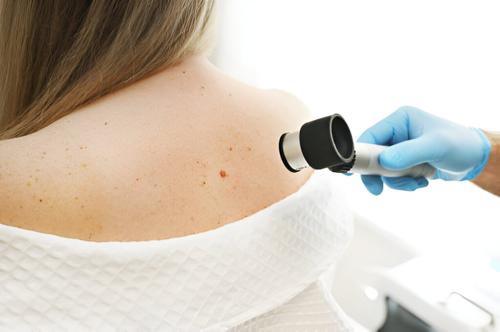 Melanoma