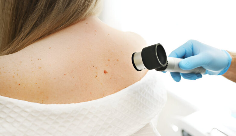 Melanoma