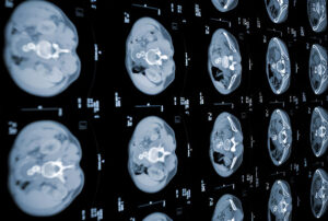 Smegenų arterioveninės malformacijos