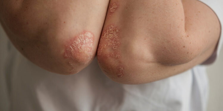 Psoriazinis artritas