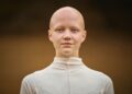 Židininė alopecija