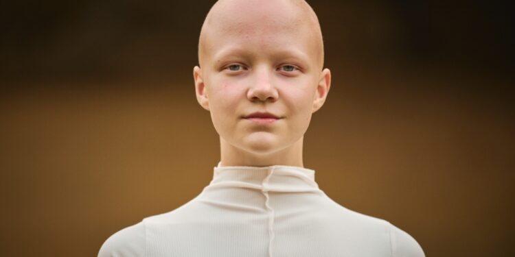 Židininė alopecija