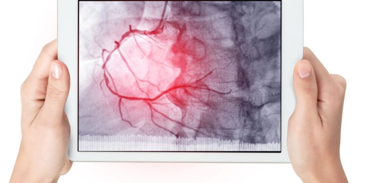Ūminė arterijų okliuzija
