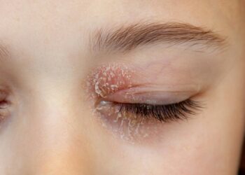 Asteatozinė (išsausėjimo) egzema: simptomai, priežastys ir gydymas