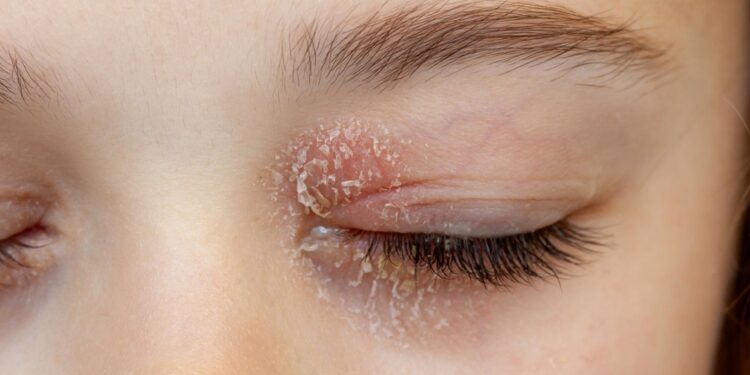 Asteatozinė (išsausėjimo) egzema: simptomai, priežastys ir gydymas