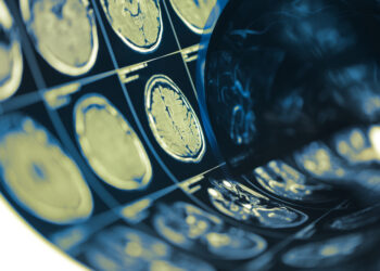 Astrocitoma: kas tai, priežastys, simptomai, tipai ir gydymas