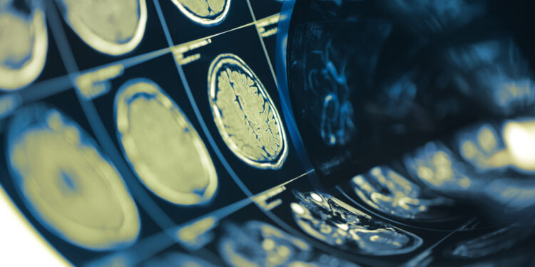 Astrocitoma: kas tai, priežastys, simptomai, tipai ir gydymas