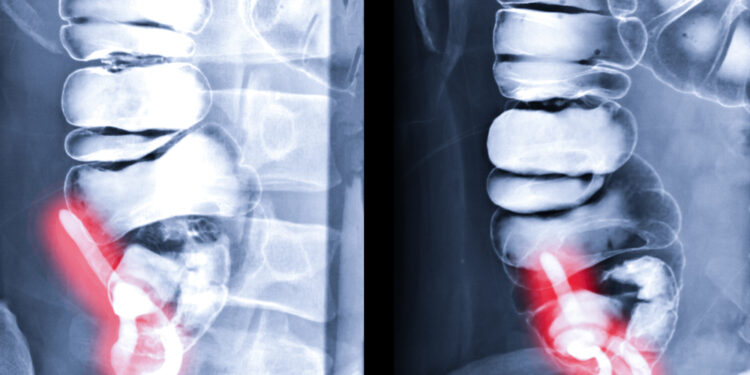 Bario klizma: procedūra, pasiruošimas ir svarbiausia informacija
