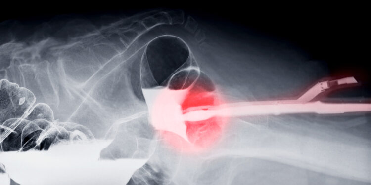 Bario sulfato klizma rektaliniu būdu