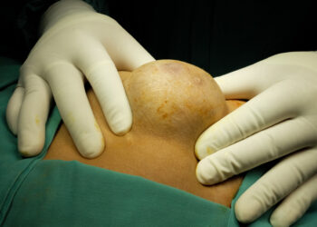 Bartholin liaukos cista: priežastys, simptomai ir gydymas