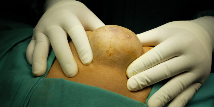 Bartholin liaukos cista: priežastys, simptomai ir gydymas