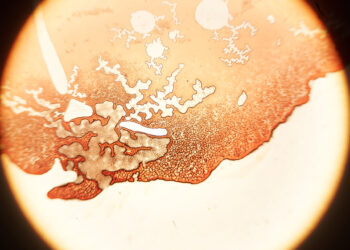 Bazofilija: simptomai, priežastys ir reikšmė