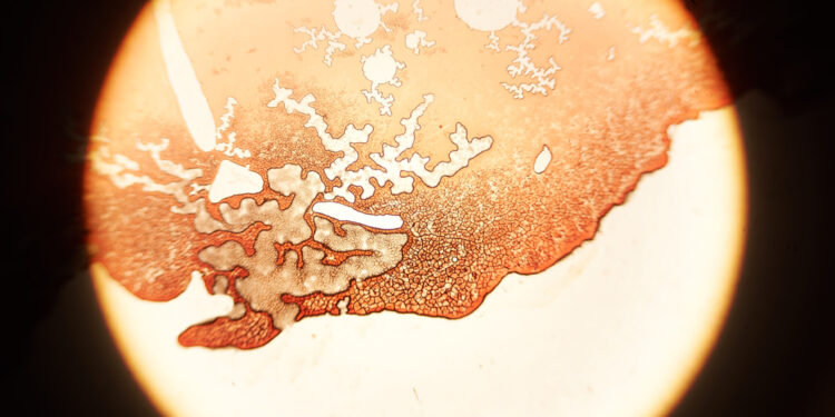 Bazofilija: simptomai, priežastys ir reikšmė