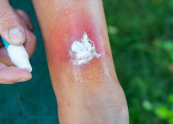 Benzokaino, cinko chlorido ir benzalkonio chlorido burnos gelis