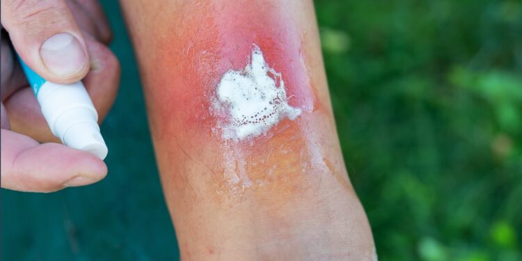 Benzokaino, cinko chlorido ir benzalkonio chlorido burnos gelis