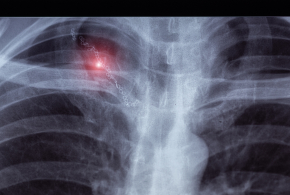 Bulinė emfizema: kas tai, priežastys ir gydymas