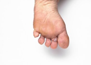 Candida auris: grybelinė infekcija, simptomai ir gydymas