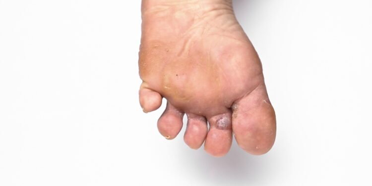 Candida auris: grybelinė infekcija, simptomai ir gydymas