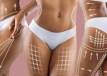 Celiulitas: simptomai, priežastys, gydymas ir sveikimas