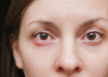 Chalazionas: simptomai, priežastys, profilaktika ir gydymas