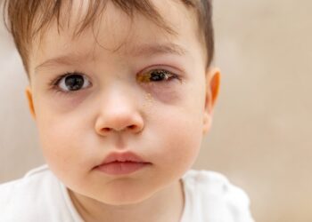 Chorioretinitas: simptomai, priežastys ir gydymo galimybės