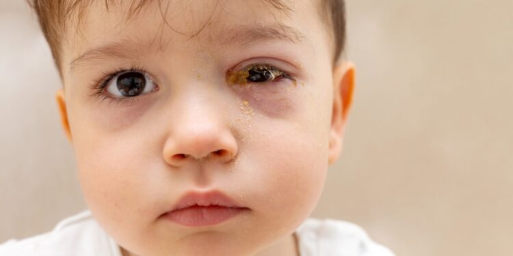 Chorioretinitas: simptomai, priežastys ir gydymo galimybės