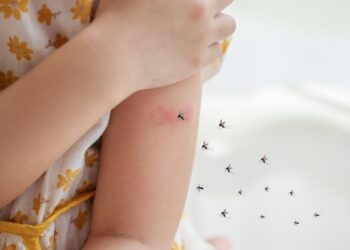 Čikungunija: Priežastys, simptomai, diagnostika ir gydymas