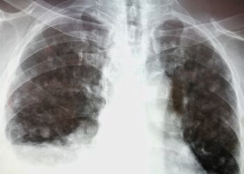 Danono liga: Priežastys ir prognozė