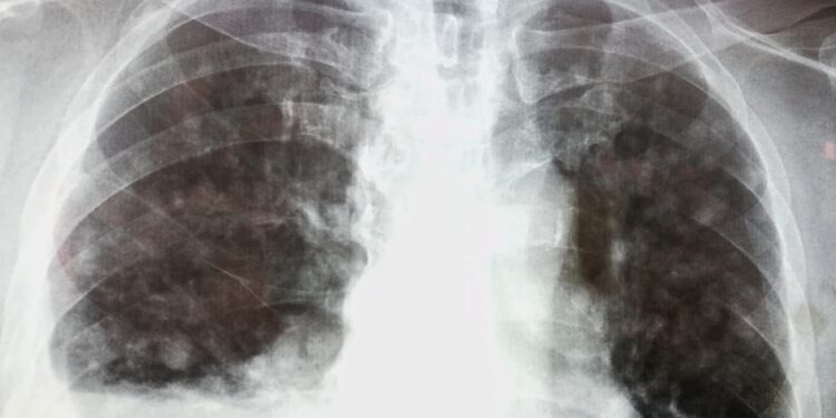 Danono liga: Priežastys ir prognozė