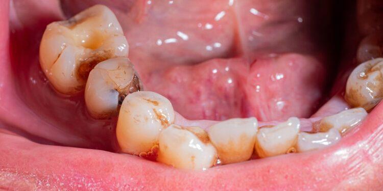 Dantų ėduonis (kariesas): simptomai, priežastys ir gydymas