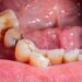 Dantų ėduonis (kariesas): simptomai, priežastys ir gydymas