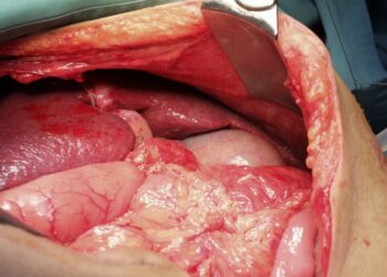 Dekstrokardija: priežastys, gydymas ir prognozė