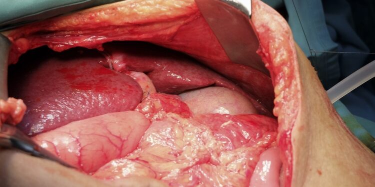 Dekstrokardija: priežastys, gydymas ir prognozė