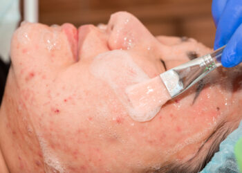 Demodeksas (veido erkutės): Folikulorum, Brevis rūšys ir gydymas