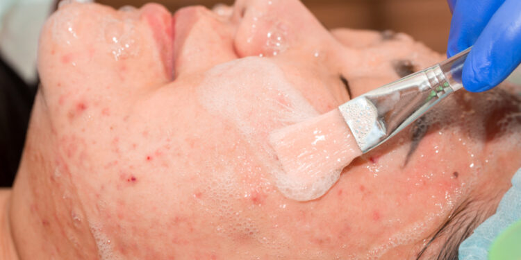 Demodeksas (veido erkutės): Folikulorum, Brevis rūšys ir gydymas