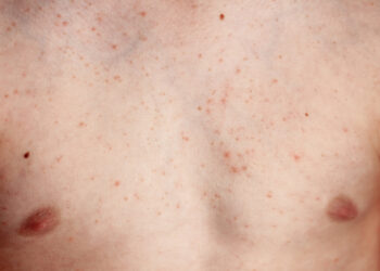 Dermatofibrosarkoma (DFSP): priežastys ir gydymas