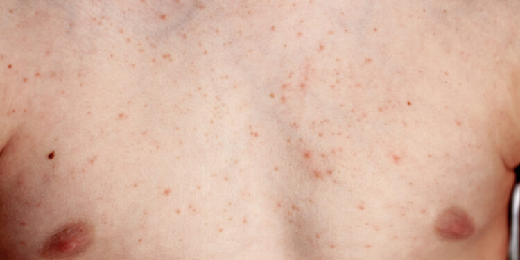 Dermatofibrosarkoma (DFSP): priežastys ir gydymas