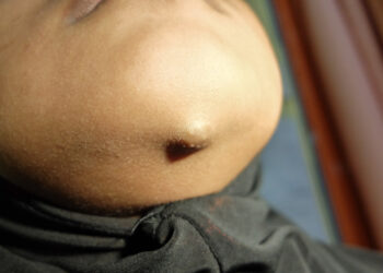 Dermatomiozitas: simptomai, priežastys ir gydymas