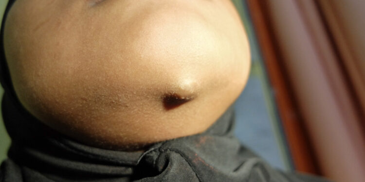 Dermatomiozitas: simptomai, priežastys ir gydymas