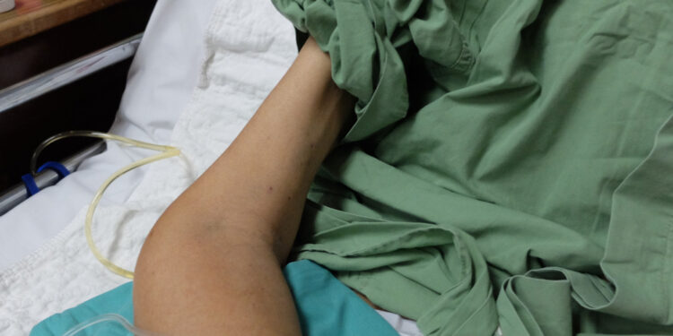 Cukrinio diabeto sukelta amiotrofija: priežastys, simptomai ir gydymas