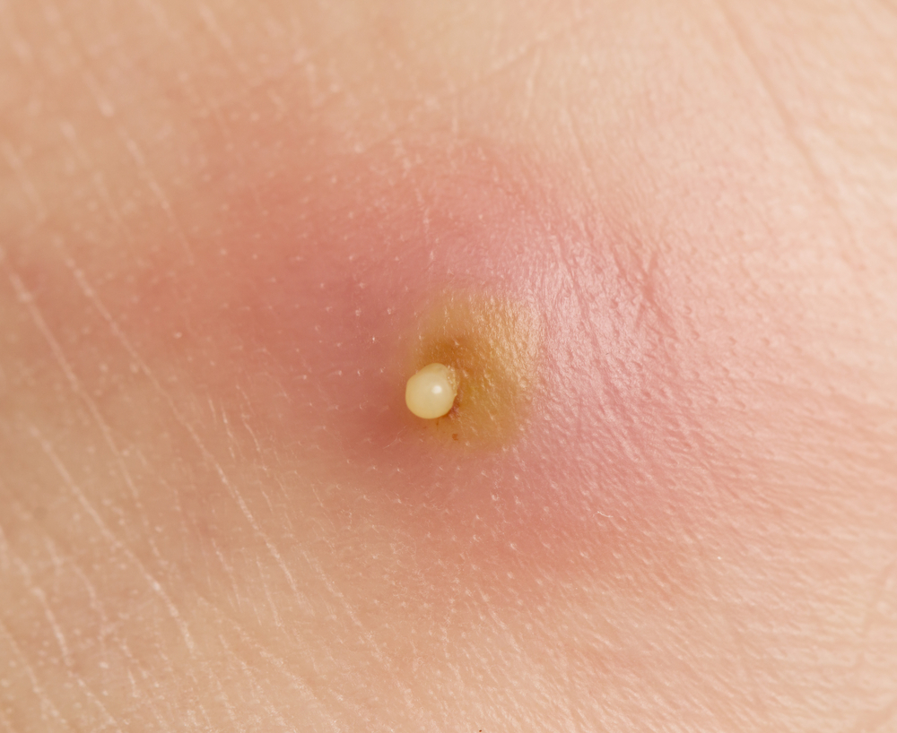 Furunkulai ir karbunkulai: simptomai, gydymas ir profilaktika